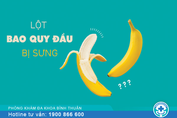 Lột bao quy đầu bị sưng: Nguyên nhân cách xử lý hiệu quả